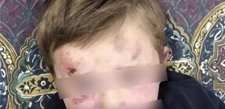 На Тернопільщині вітчим жорстоко побив 4-річну дитину: хлопчик у лікарні
